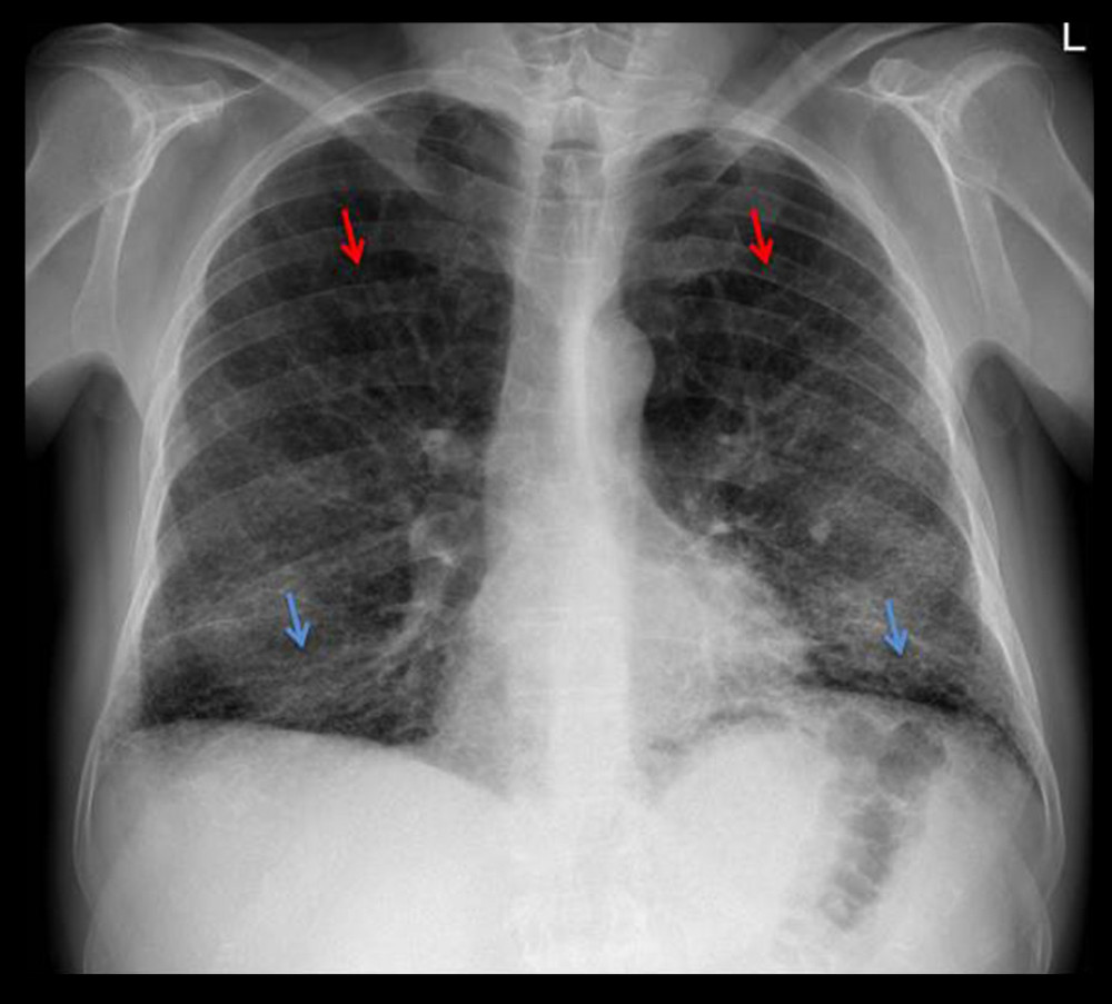 Chest radiograph, with posteroanterior projection. Diffuse reticular pattern seen predominantly in the lower fields (blue arrows). Upper lobes predominant emphysema (red arrows).