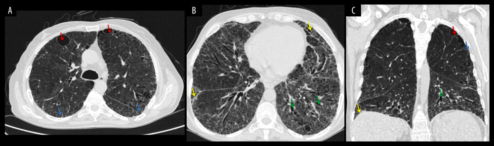 (A) High-resolution computed tomography (HRCT) of the lungs, axial plane. Paraseptal emphysema (red arrows) with interlobular septal thickening (blue arrows) predominantly in the upper lobes. (B) HRCT, axial plane. Areas of ground-glass opacities and lung fibrosis with reticulation (yellow arrows) and bronchiectasis (green arrows) predominantly in the middle and lower parts of both lungs. (C) HRCT, coronal reconstruction paraseptal emphysema (red arrow) with interlobular septal thickening (blue arrow) predominantly in the upper lobes. Areas of ground-glass opacities and lung fibrosis with reticulation (yellow arrow) and bronchiectasis (green arrow) predominantly in the middle and lower parts of both lungs. No mediastinal or hilar lymphadenopathies are observed.