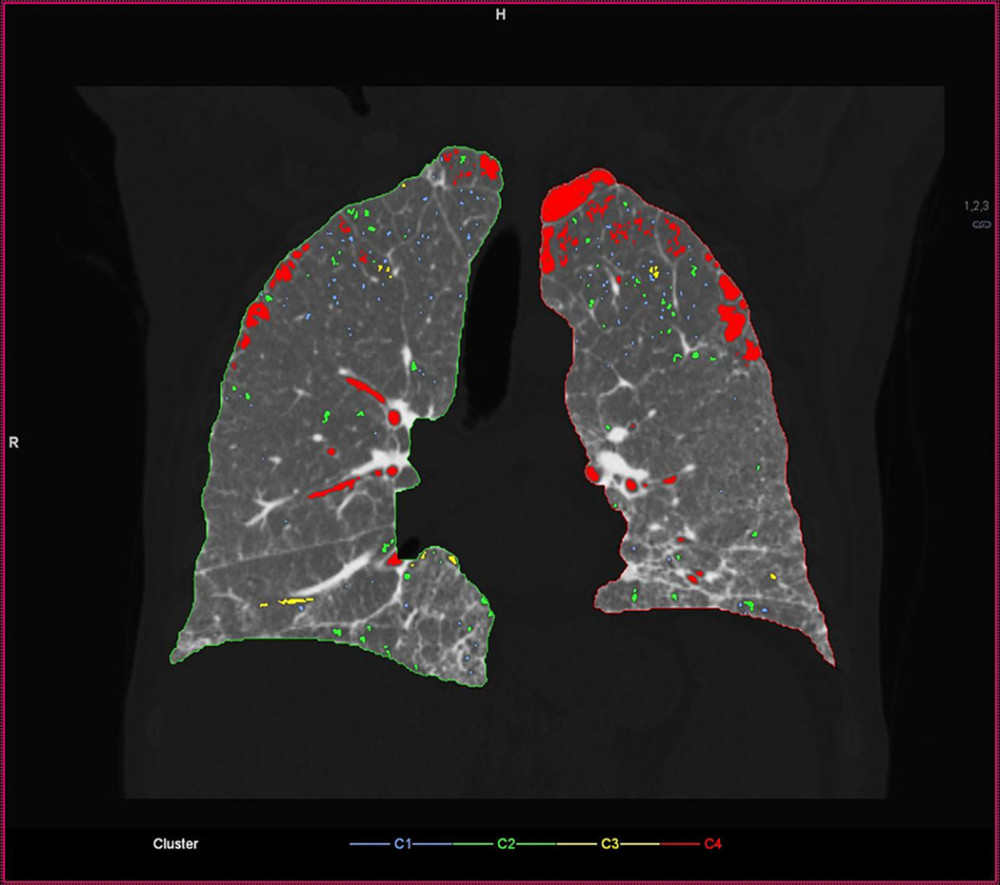 Reconstruction (3D Pulmo software) shows emphysema (areas of less than −950 HU) in red.