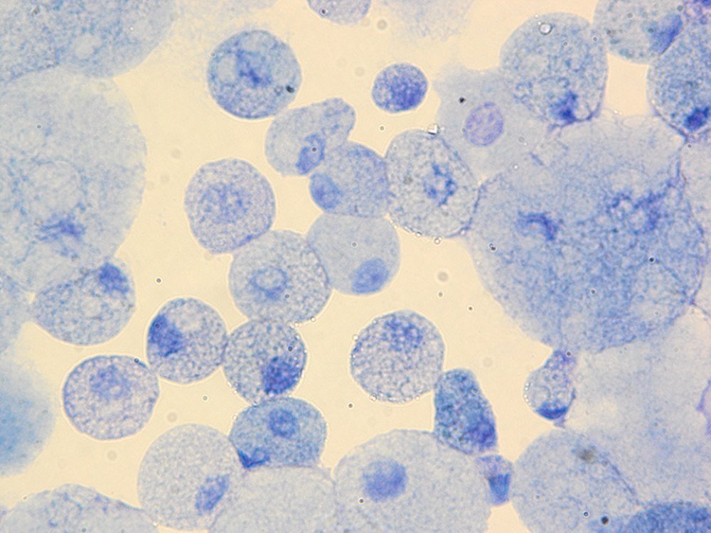 Multivacuolated (foamy) macrophages stained blue with May-Grünwald-Giemsa method in bronchoalveolar lavage fluid of patient with Niemann-Pick disease type B. Light microscope, immersion oil, magnification 1000×.