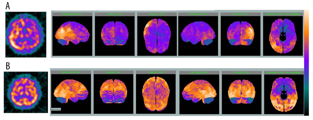 Brain perfusion SPECT (Tc-99m HMPAO) images. 3D Talairach cortical perfusion images of the perfusion SPECTs (A) on the day of seizure (4 hours after seizure onset), and (B) after 2 months. (A) On the day of the seizure, hyperperfusion was observed in the right lateral parietal and in the right occipital and right lateral temporal lobes. The patient was sedated during the scan. (B) On follow-up after 2 months, except for mild hypoperfusion in the frontal lobes, the previous perfusion abnormality had disappeared. There was not second seizure attack.