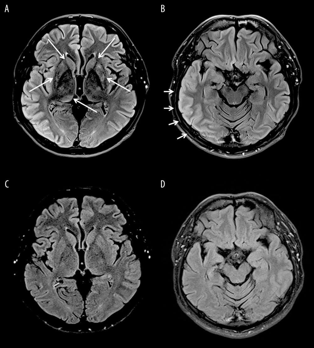 Magnetic resonance images on the day of seizure (A, B) and after 2 months (B, C). T2 flair image on the day after the seizure episode showing T2 hyperintensity without diffusion restriction in both caudate nucleus (arrows), putamen (arrows), right thalamus (arrows), pulvinar, and both middle cerebellar peduncles. Osmotic demyelination syndrome was suggested. (B) Diffuse T2 hyperintensity with mild diffusion restriction in right cerebral cortical area (arrows). Cortical signal change was predominantly in the insular temporal and parieto-occipital lobe. (C, D) After 2 months, follow-up MR showed that T2 hyperintensity was normalized (T2-weighted images).