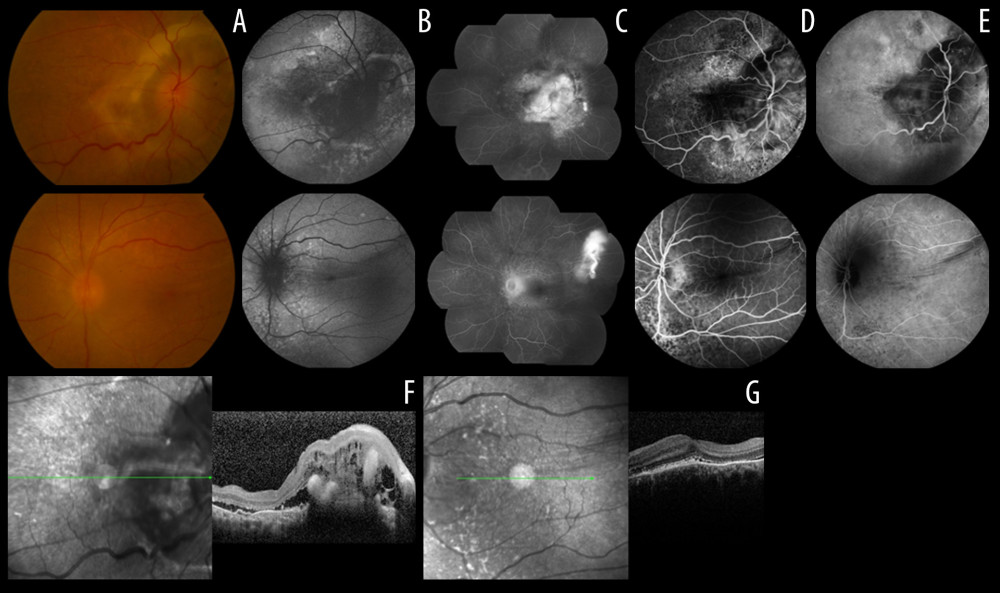 Color fundus photography (A), fundus autofluorescence (B), fundus fluorescein angiography (C), late-phase fundus fluorescein angiography (D), late-phase indocyanine green angiography (E) of the patient at baseline (right eye in upper line, left eye in lower line), and OCT images of the right eye (F) and of the left eye (G) of the patient at baseline.