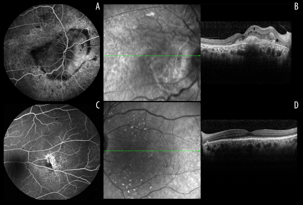 Late-phase fundus fluorescein angiography (A) and OCT image (B) of the right eye after five bevacizumab intravitreal injections; late-phase fundus fluorescein angiography of the superotemporal midperiphery of the left eye (C) and OCT image of the left eye (D) 4 months after discontinuation of oral corticosteroids.
