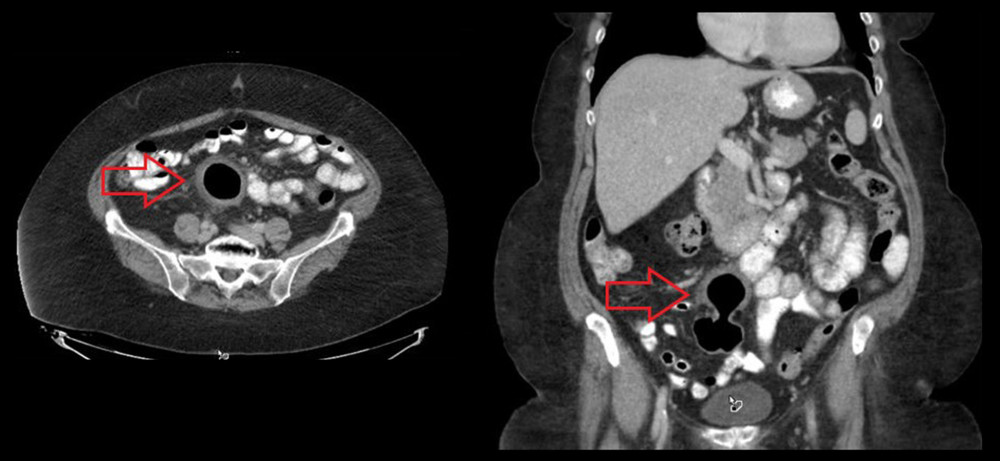 CT of the diverticulum in axial, coronal imaging of giant diverticulum at presentation. Red arrow denotes gas-filled diverticulum.