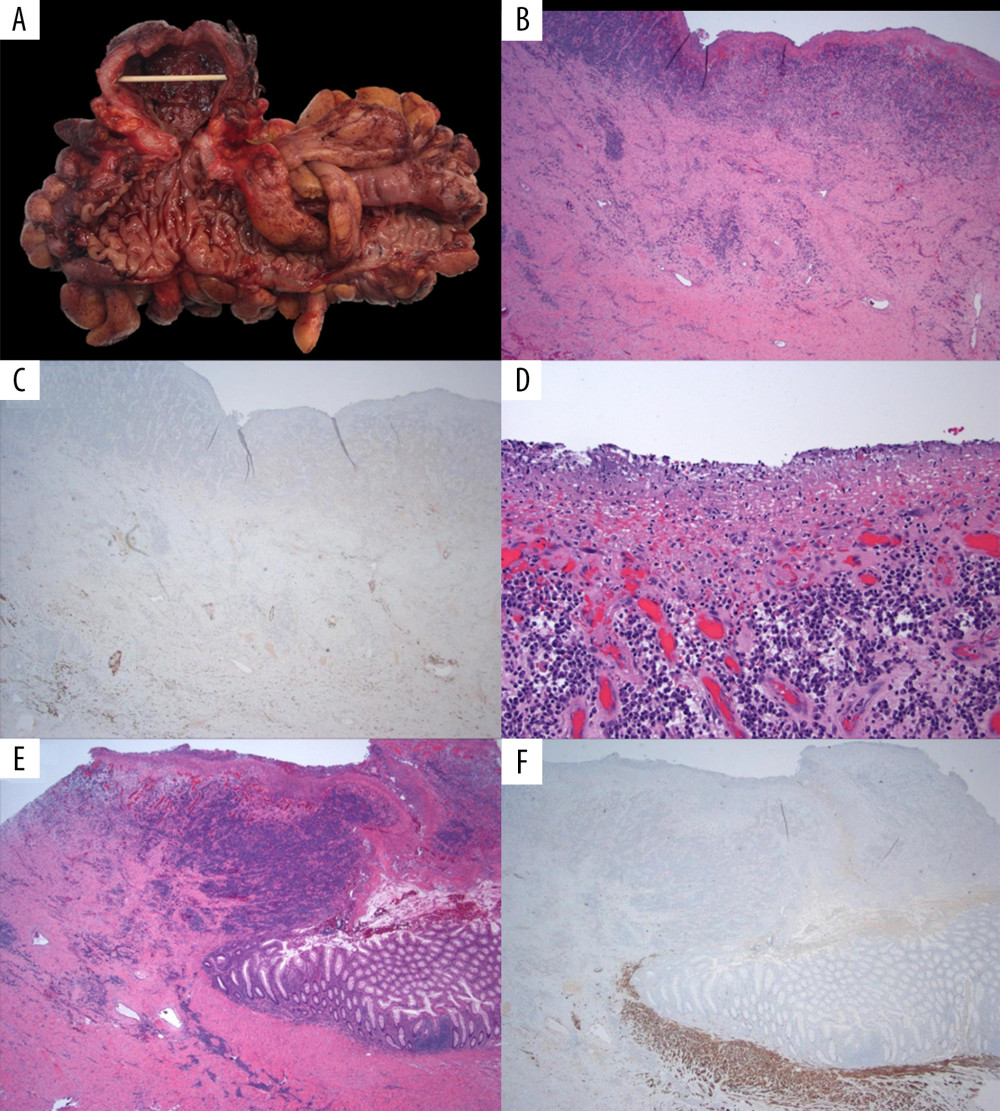 Giant diverticulum histology, Case 2. (A) Gross image of open colon with diverticulum (A). Fibrotic wall of giant diverticulum (40×) (B). Immunohistochemical stain for smooth muscle (desmin) demonstrating absence of muscularis mucosae and muscularis propria (40×) (C). Higher-power representative image of the diverticulum mucosal surface showing acute inflammation, granulation tissue, and absence of epithelium (200×) (D). H&E (E) and corresponding desmin immunohistochemical stain (F) demonstrating an abrupt end of muscularis propria at the transition point into the fibrotic wall of the diverticulum (40×). Features compatible with Type 2 giant diverticulum (inflammatory type).