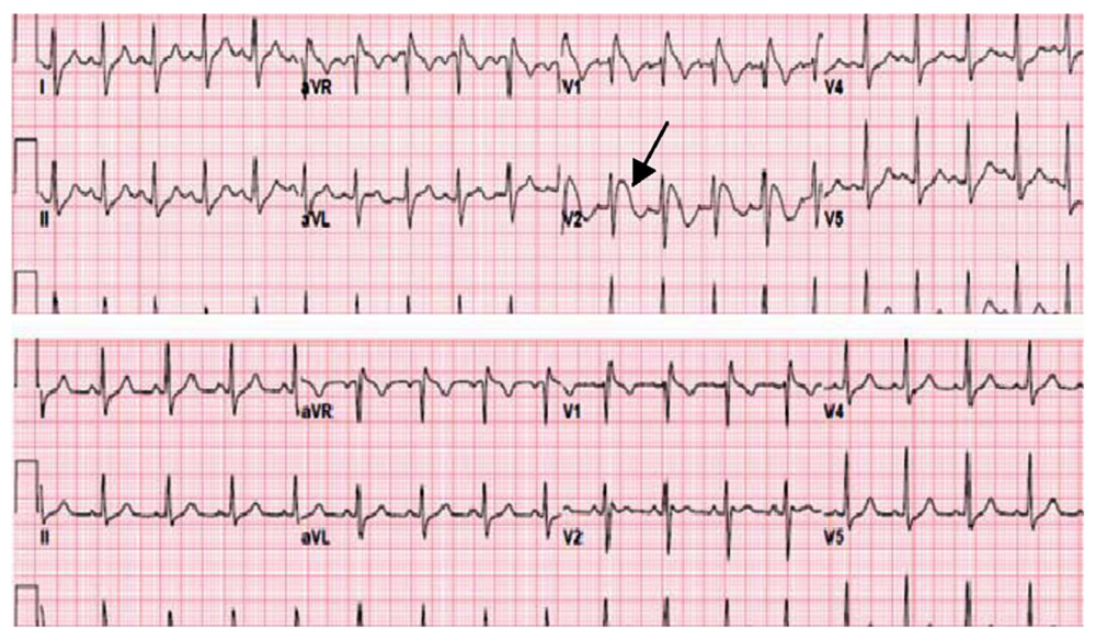 Electrocardiogram (ECG) tracing in a 26-year-old male presenting with acute encephalopathy, acute hypoxic respiratory failure, and acute hyperkalemia, resulting in Brugada-like ECG changes. Top ECG tracing obtained while serum potassium measured 7.2 mmol/L, demonstrating the type 1 “coved” Brugada pattern with concave, ST-segment elevation most prominent in leads V1 and V2 (arrow). Bottom ECG tracing demonstrating resolution of ST-segment changes after correction of serum potassium to 4.4 mmol/L.