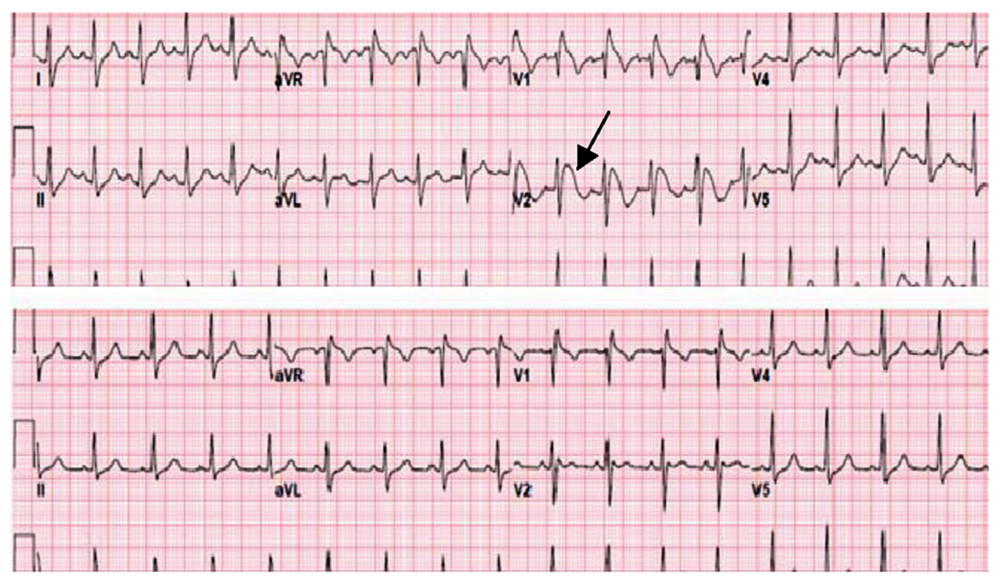 severe hyperkalemia ecg