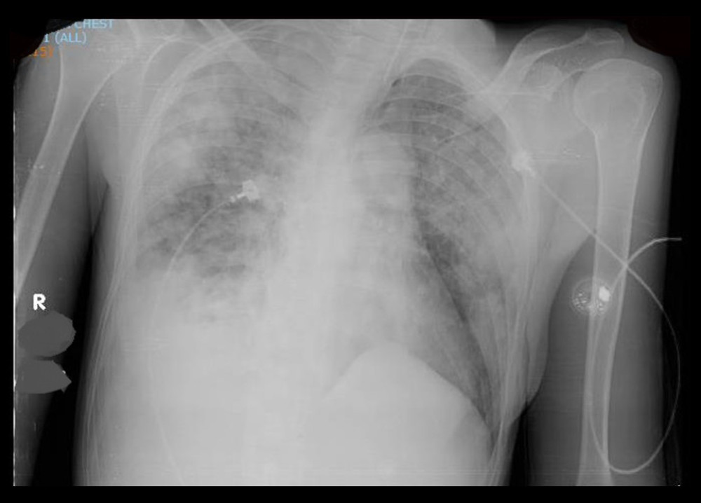 Chest X-ray. Marked bilateral consolidations with hyperdensities in the apex and base of the right lung.