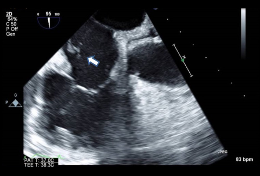 Transesophageal echocardiography (TEE). A small mobile mass is seen on the eustachian valve (full arrow).