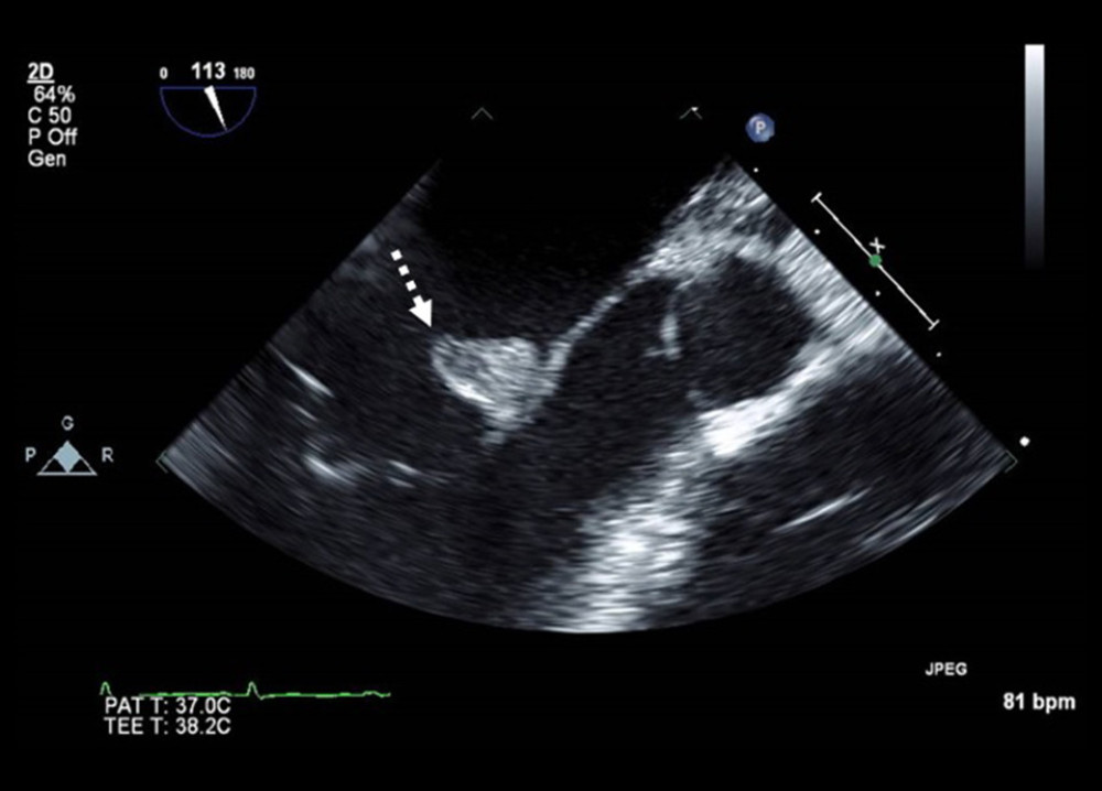 Transesophageal echocardiography (TEE). A large 2×1.5 cm vegetation is seen at the anterior leaflet of the mitral valve (dotted arrow).