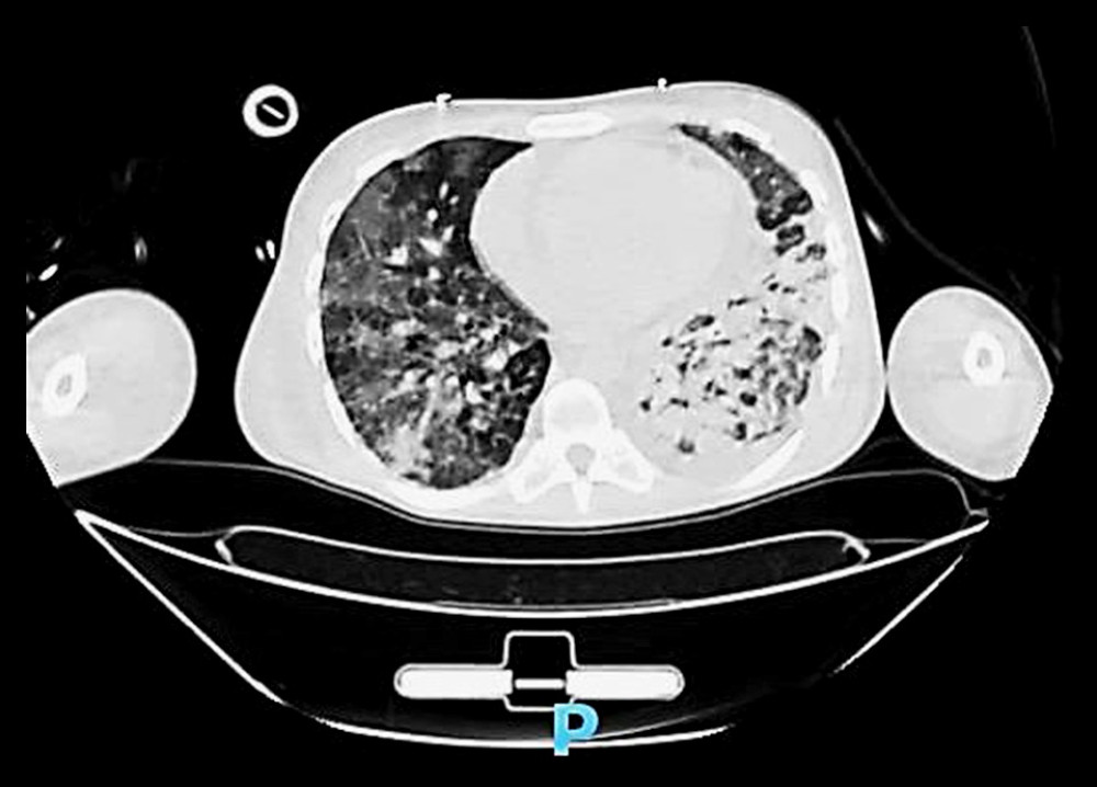 Chest CT. Massive bilateral consolidations with cavitation are seen on RUQ with septation.