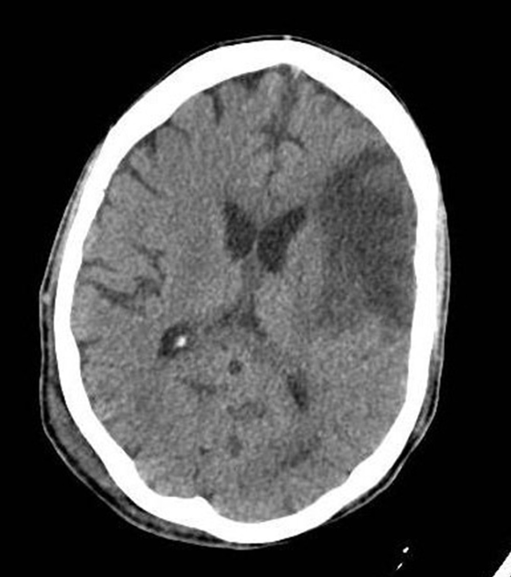 Brain CT, showing a large frontoparietal infarct.