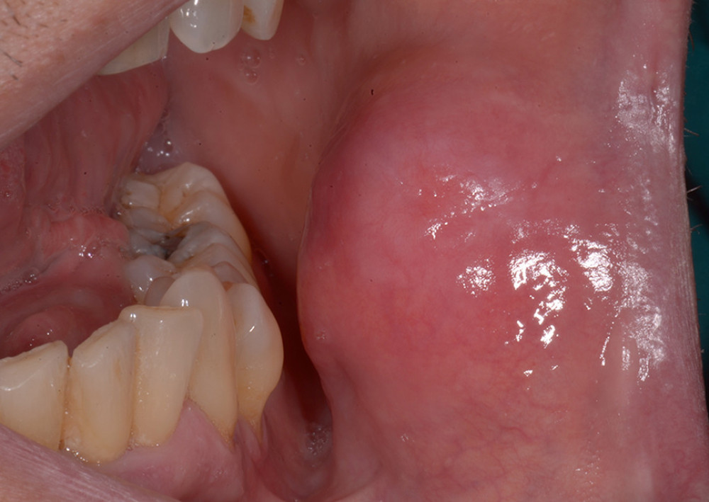 Intraoral examination with tumefaction visible in the buccal mucosa and no signs of trauma.