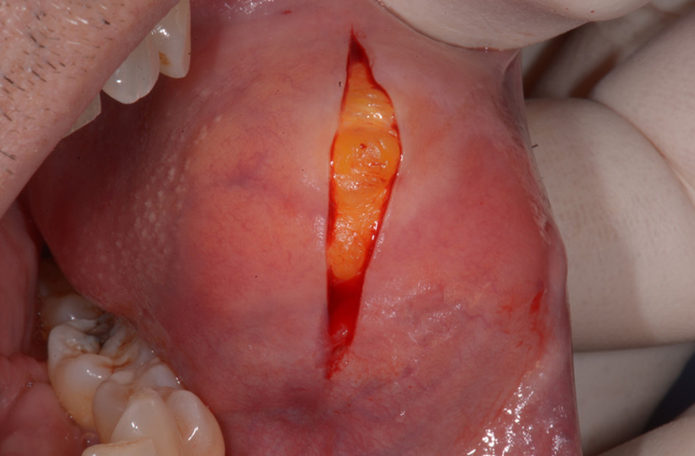 Vertical surgical incision of the overlaying mucosa with a 15c blade.