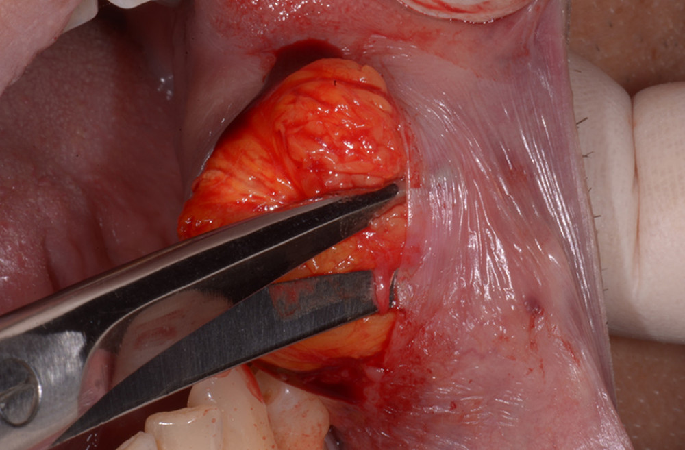 Peripherical dissection around the enclosing fascia with Metzenbaum scissors.