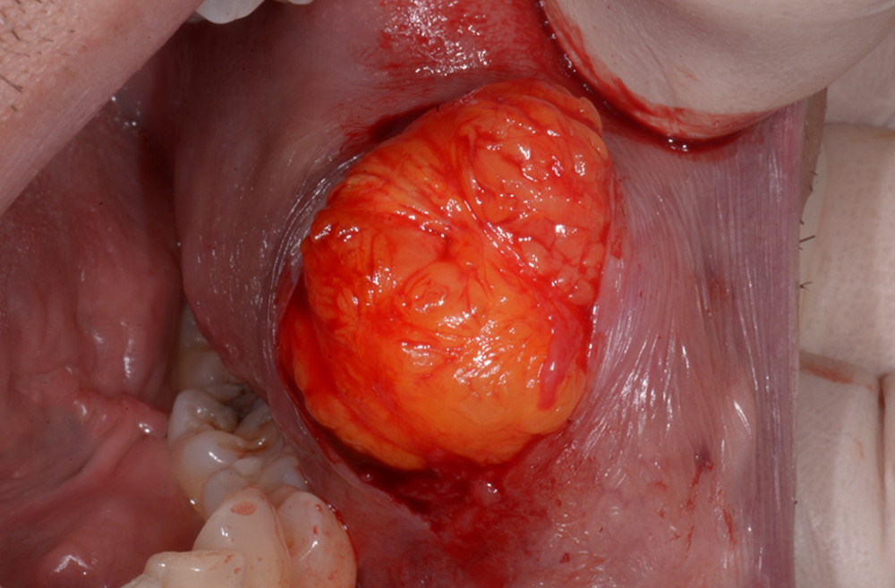 Excision of the lesion using pressure applied extraorally to push the lesion from its site.