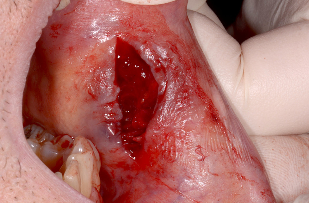 Vertical incision after the excision, showing the site after removal of the lesion.