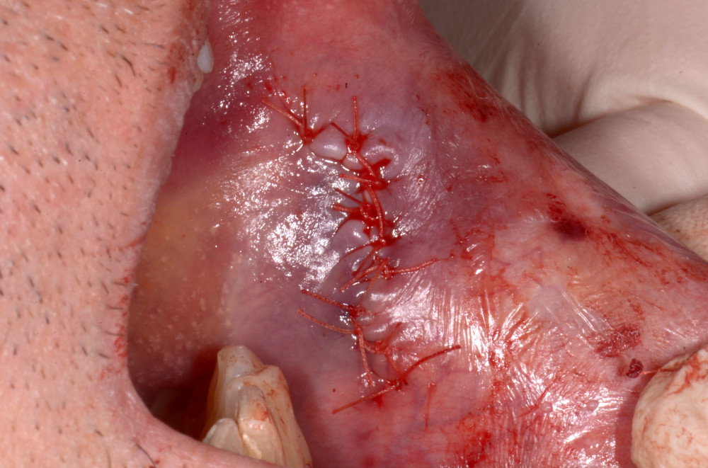 Suture points applied using simple Vicryl 3.0 resorbable suture.