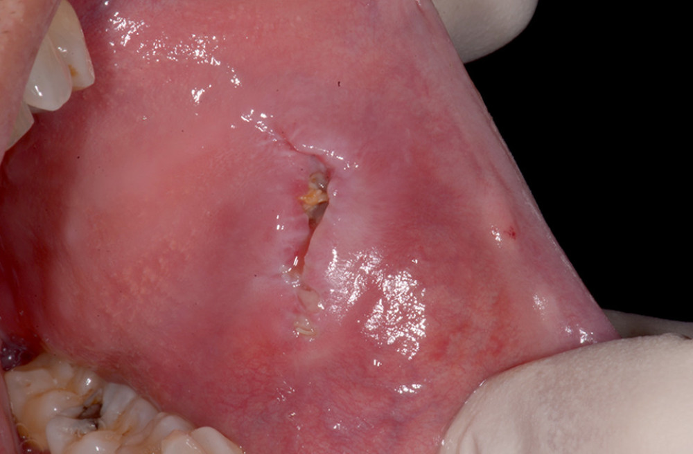 On the 7th day after suture removal, the patient was still applying intraoral disinfectant (chlorhexidine 0.2%).