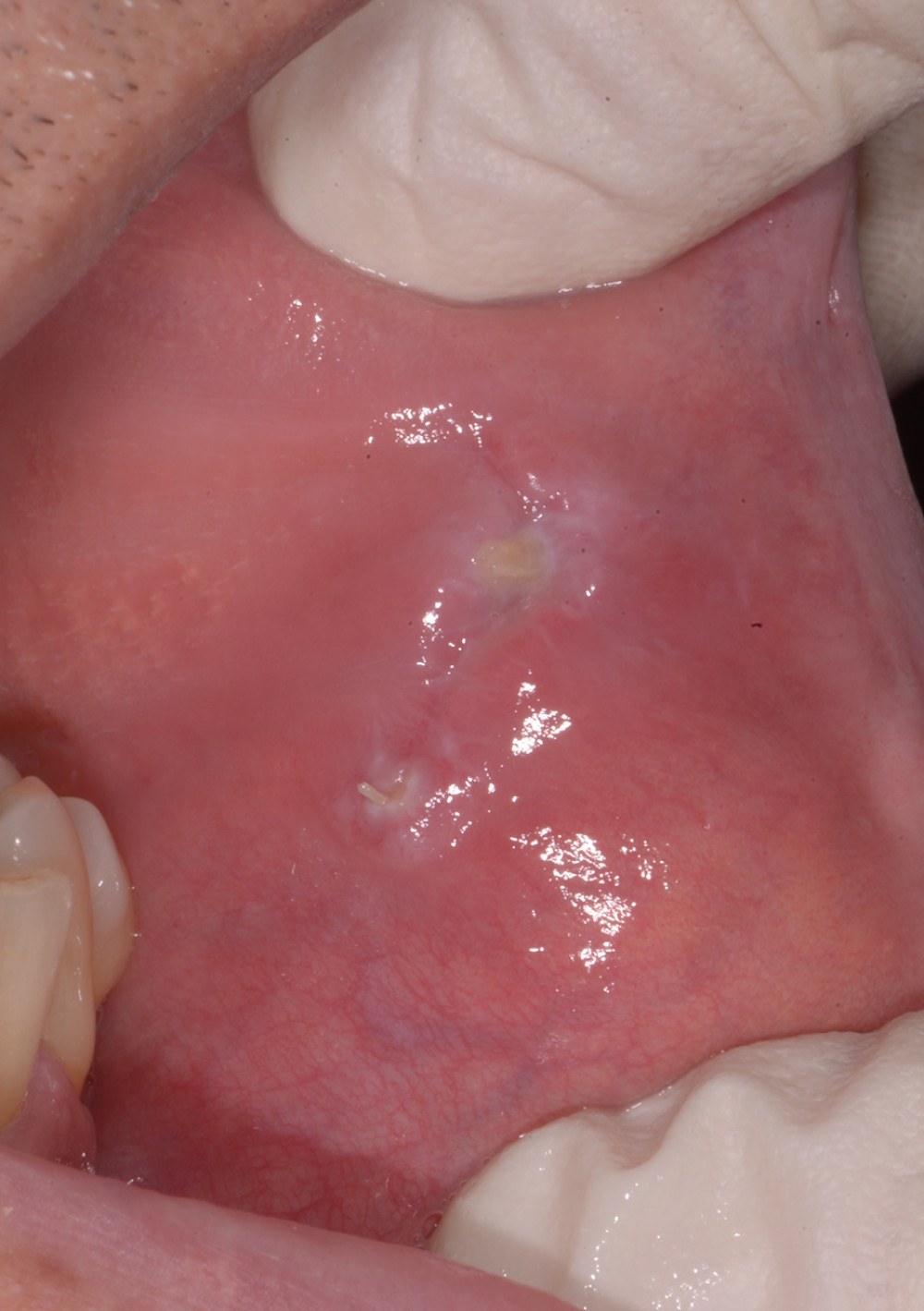 The 14th day post-op examination showed closure of the incision margin, and intraoral disinfectant therapy was discontinued.