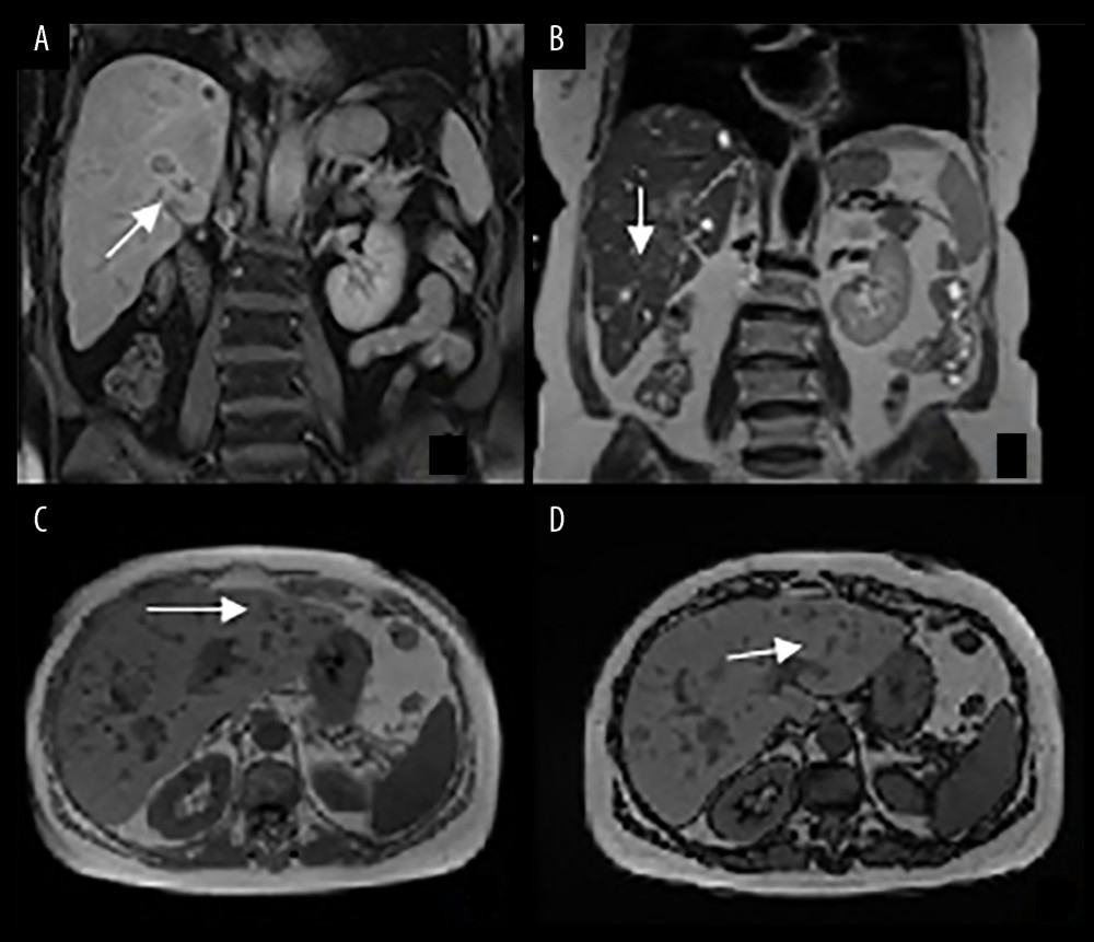 (A–D) MRI coronal and axial scans showing ectatic intra- and extrahepatic biliary tracts, as well as inhomogeneous signal intensity due to the presence of multiple centimetric nodular areas partly confluent (arrows).