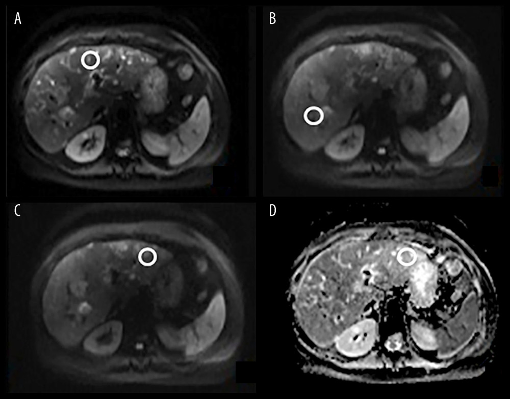 (A–D) MR axial diffusion-weighted imaging (DWI) scans. Dilated intrahepatic biliary tracts (empty circle).