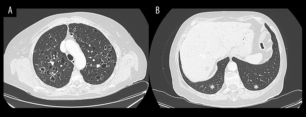 (A, B) axial thoracic CT images (lung window) shows typical confluence of cysts in bizarre shapes with predilection for the middle and upper zones (arrows) and regional sparing of the costophrenic recesses (asterisks).