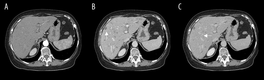 (A–C) Axial contrast-enhanced abdominal CT shows multiple diffuse hypodense nodules, some of them confluent (arrows).