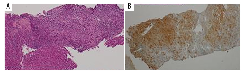 (A) Hepatic core needle biopsy: Hematoxylin/eosin-stained slides show hepatic parenchyma almost completely substituted by a middle-size cell population characterized by nuclei with membrane irregularity, with incision, dispersed chromatin, and slightly eosinophilic cytoplasm. A mixed infiltrate composed of lymphocytes, plasma cells, histiocytes, and numerous eosinophil granulocytes were also present around the lesions. There was moderate fibrosis, with disappearance of the portal spaces. (B) Immunohistochemistry showed positivity for CD1a.