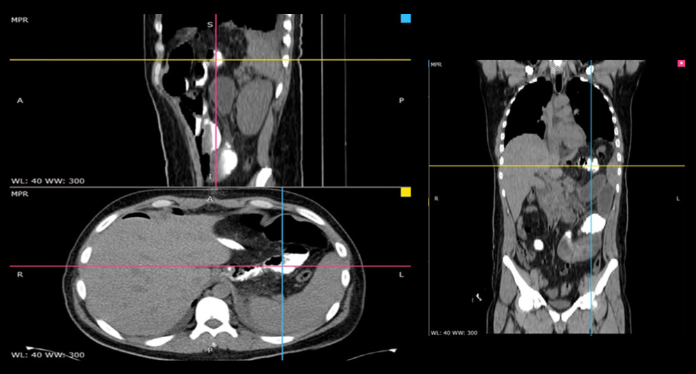 Computed tomography scan: abdominal fluid accumulation and phytobezoar esophagogastric obstruction.