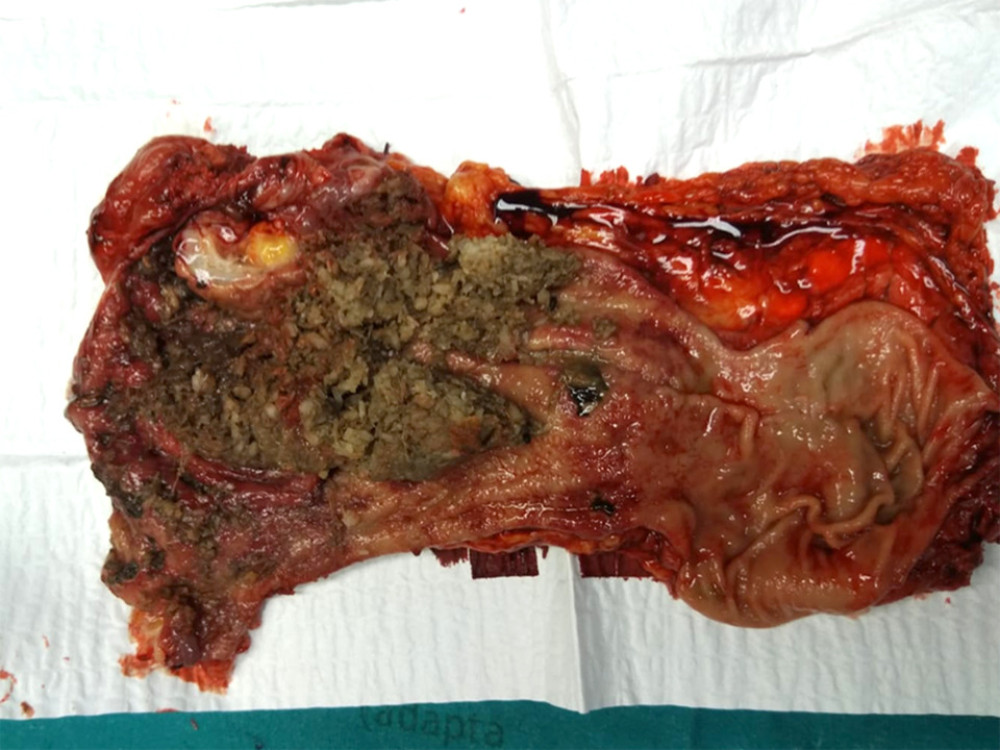 Surgical specimen: phytobezoar within the gastric plication, ischemic necrosis, and perforation.