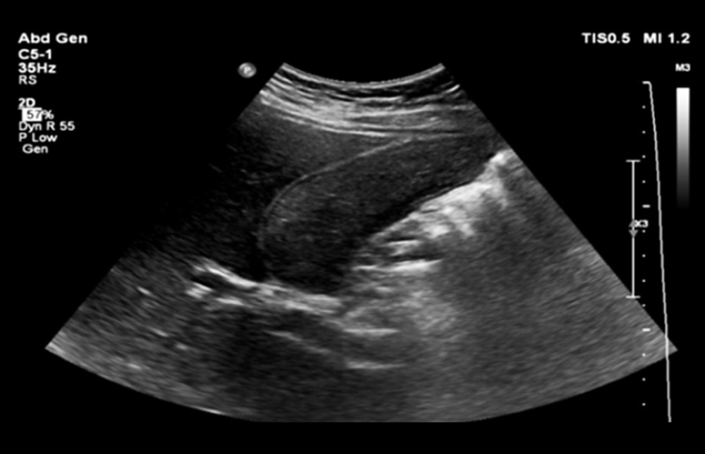 Ultrasound image showing gallbladder filled with sludge. No discrete shadowing gallstones or polyps were visualized on ultrasound.