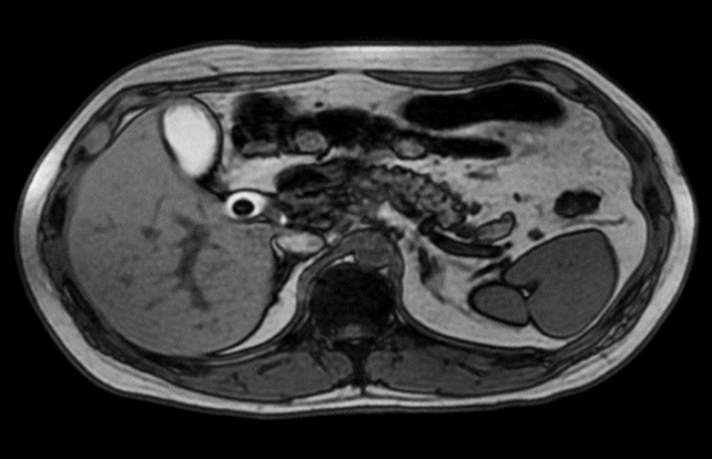 Magnetic resonance imaging showing thickening of the gallbladder wall without bile duct obstruction. This finding points to acute cholecystitis.