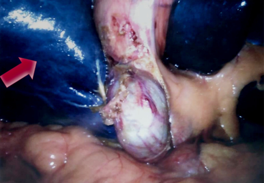 Intra-operative laparoscopic image demonstrating the blue color of the liver. Note the normal color of surrounding tissues.