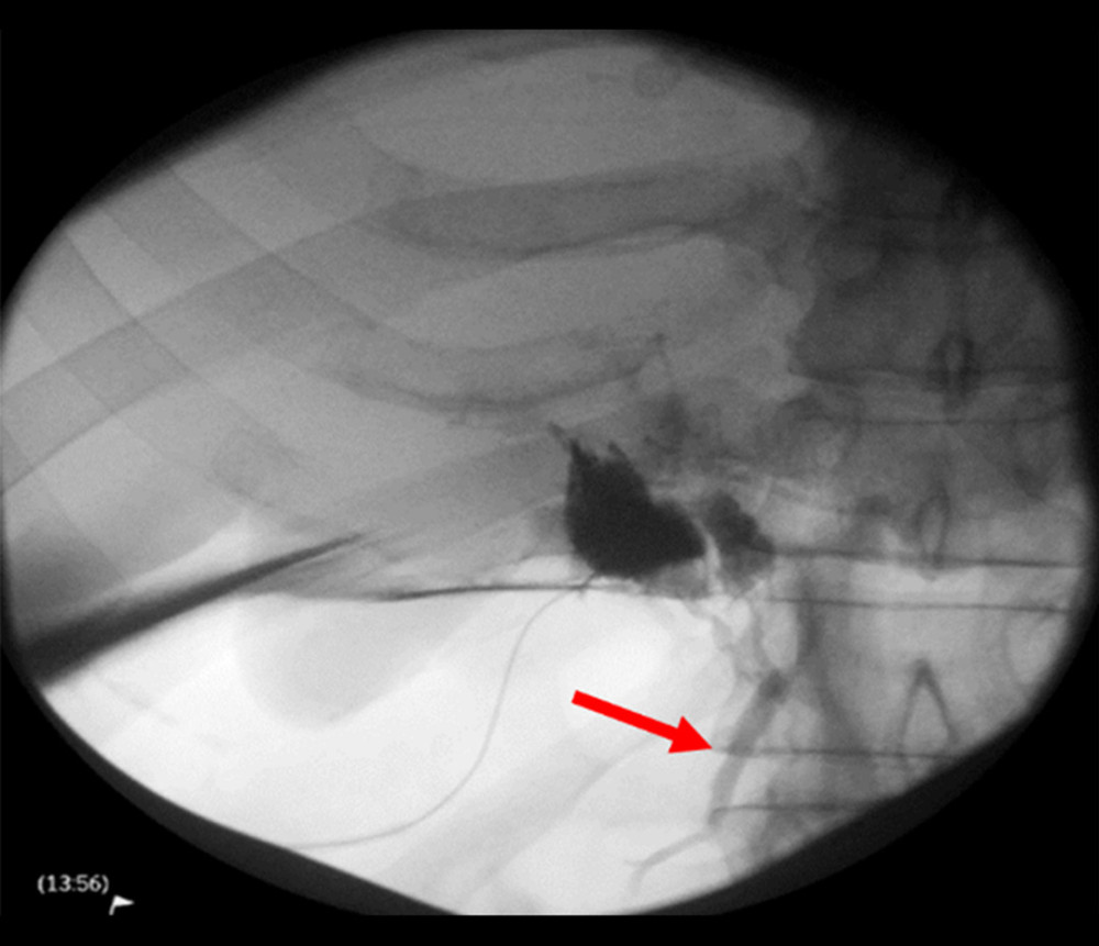 Intra-operative cholangiogram showing a patent common bile duct (arrow) without stones.