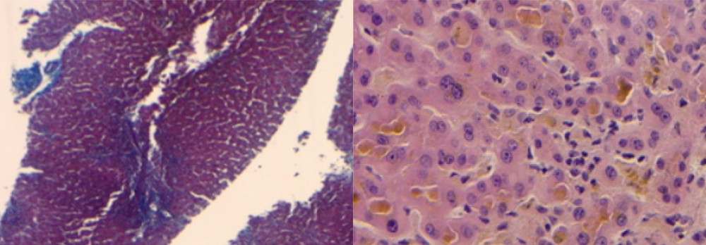 Abundant bile plugging is seen within the bile canaliculi. Iron stain reveals the presence of minimal iron within the hepatocytes. Trichrome stain reveals no evidence of fibrosis or cirrhosis.