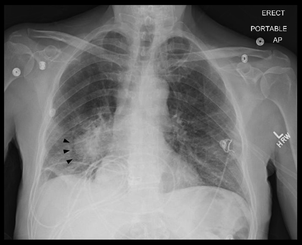 Chest x-ray showing right-sided infrahilar mass with adjacent subsegmental atelectasis (black arrow heads).