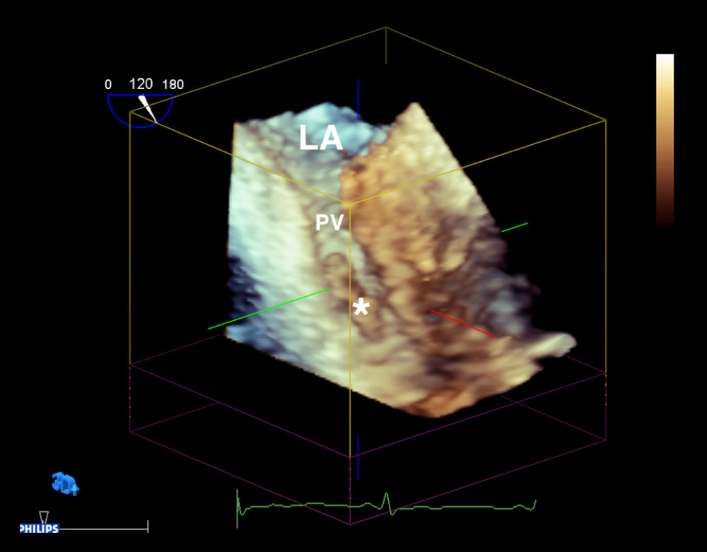 3D transesophageal echocardiography (TEE) showing left atrium (LA) and pulmonary vein (PV) with thrombus formation (white asterisk).