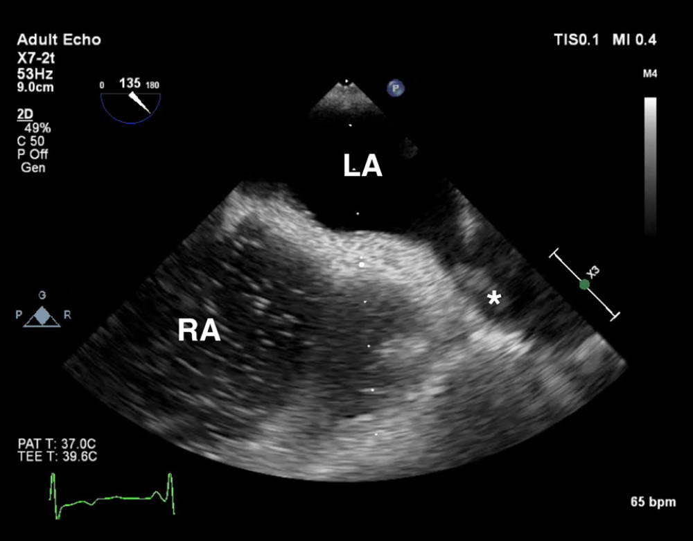Mid-esophageal view 2D transesophageal echocardiography (TEE) showing the left atrium (LA) and right atrium (RA) as well as thrombus inside the pulmonary vein (white asterisk).