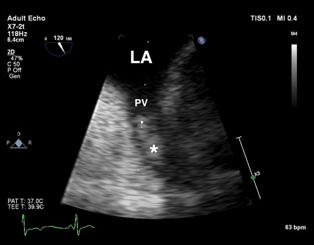 Magnified mid-esophageal view of the 2D transesophageal echocardiography (TEE) showing left atrium (LA), pulmonary vein (PV), and thrombus (white asterisk).