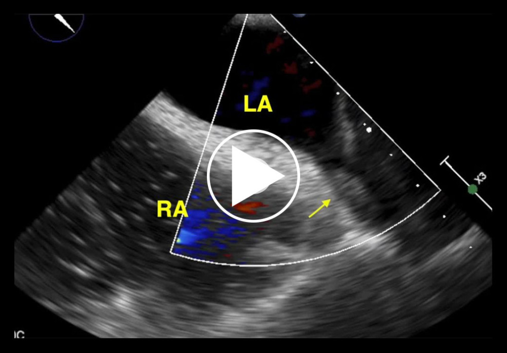 Color Doppler mid-esophageal view of transesophageal echocardiography (TEE) corresponding to Figure 2, showing left atrium (LA), right atrium (RA), and mobile pulmonary vein thrombus (yellow arrow).
