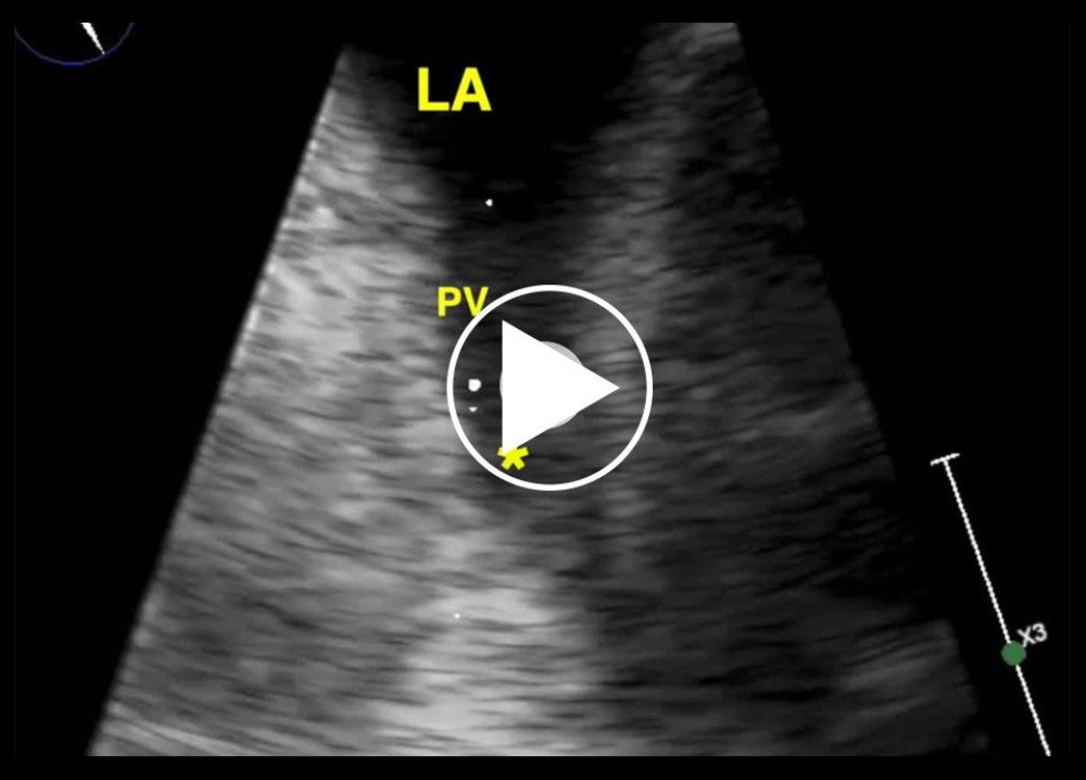 Magnified video of mid-transesophageal echocardiography (TEE) corresponding to image 3, showing left atrium (LA), pulmonary vein (PV), and thrombus (yellow asterisk).