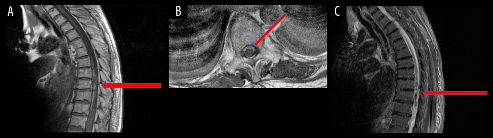 (A–C) Features of acute bleeding in the thoracic spine, visible at the Th7-Th11 level. The changes were the most widespread at the Th9 level, where they narrow the spinal canal to 8 mm, which corresponds to absolute narrowing of the spinal canal. (A) T1-dependent sagittal image; arrow denotes weakly textured pathological masses in the ventral part of the spinal canal, probably intrathecal. Their signal and lack of contrast suggest acute hemorrhagic changes. (B) T1-dependent transverse image, at level Th8. Notice the lighter color in the ventral spinal canal, indicating the presence of blood (arrow). (C) STIR sagittal image showing dark signal intensity indicating hemorrhage (arrow).