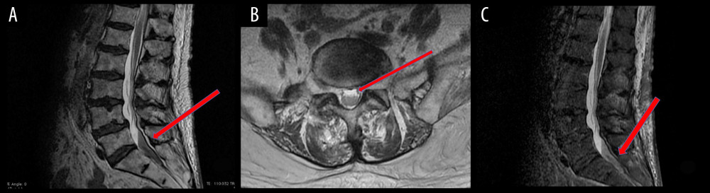 (A–C) Notice features of acute bleeding in the lumbosacral spine at the L5–S2 segment. (A) T2-dependent sagittal image; arrow denotes an intrathecal pathological mass measuring 49×12×9 mm (hypointense in the image). (B) T2-dependent transverse image, at level L5/S1. Notice the hyperintense signal of blood (arrow). (C) STIR sagittal image showing an intrathecal pathological mass at the L5–S2 segment of the spinal cord (arrow).