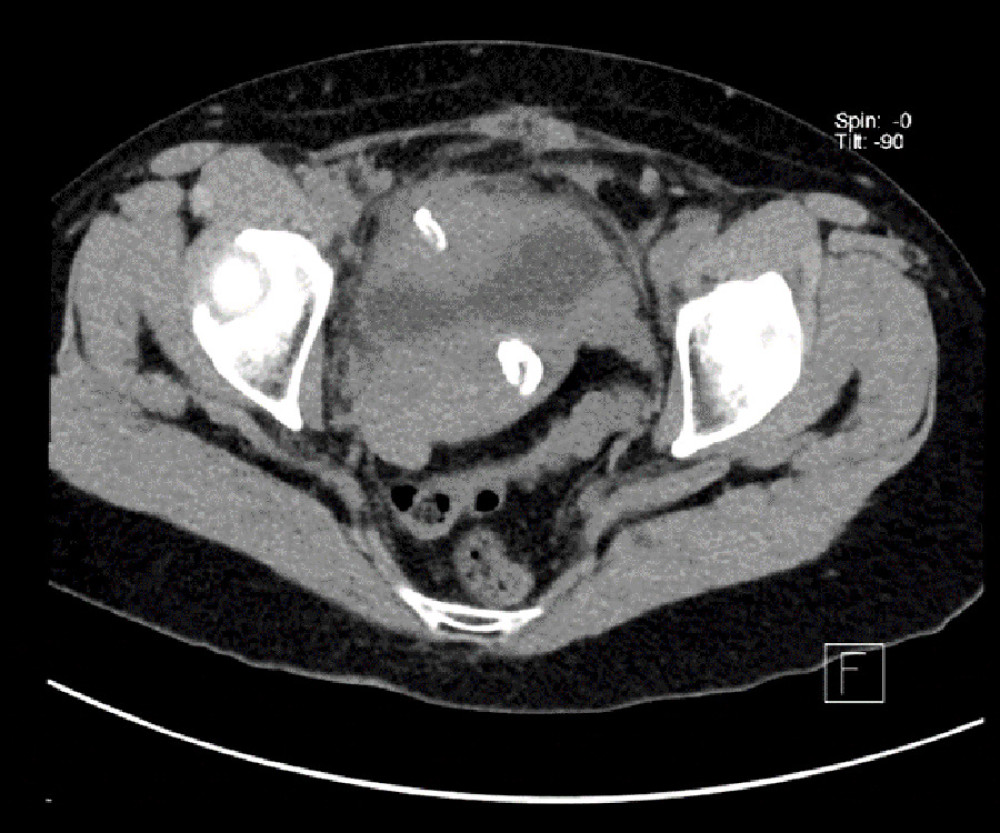 Filshie clip within bladder wall abscess in CT kidneys ureters bladder.