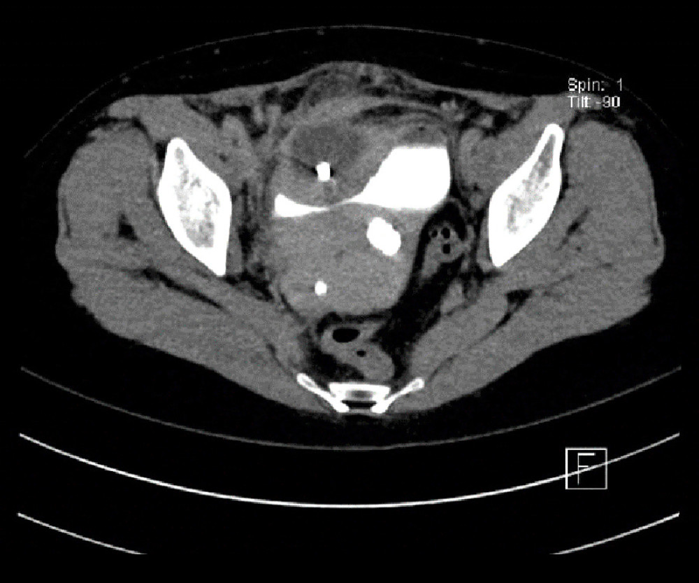 Filshie clip within bladder wall abscess in CT urography post-contrast.