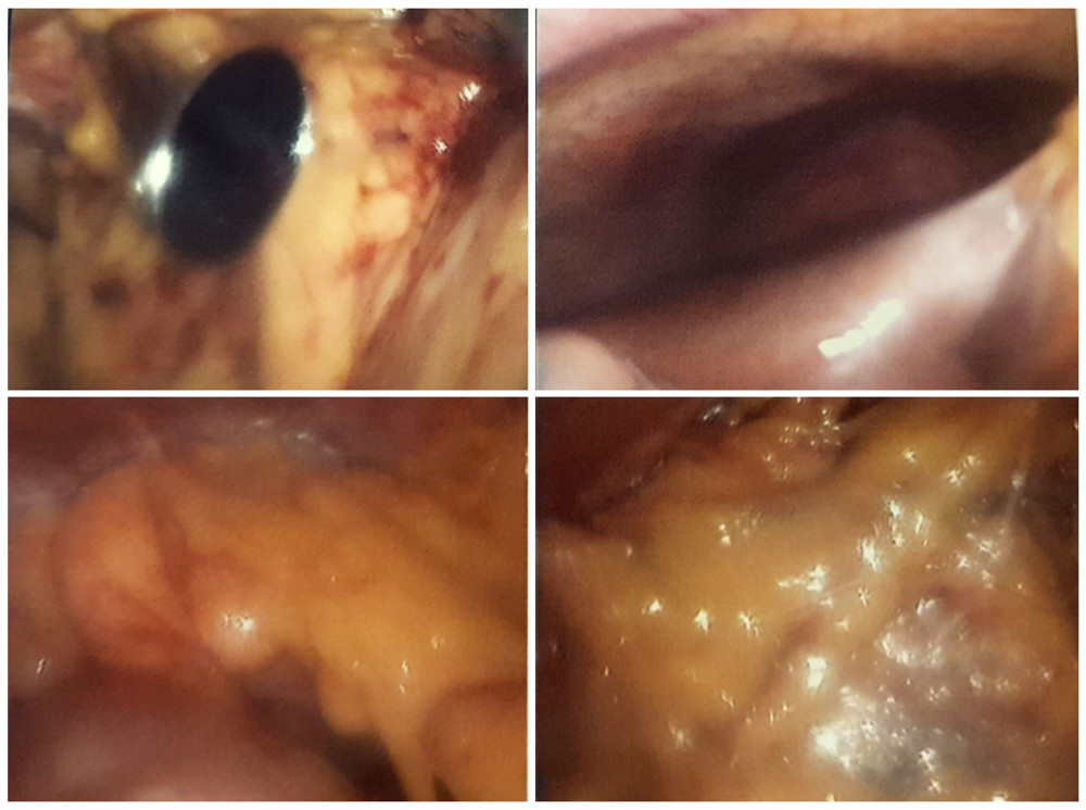 Dense omental adhesions seen on initial diagnostic laparoscopy.