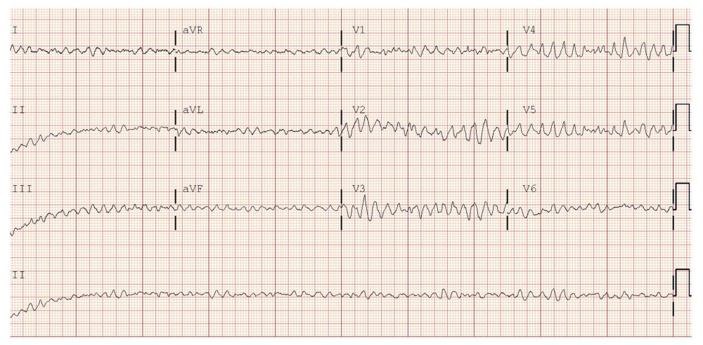 Electrocardiogram showing ventricular fibrillation.