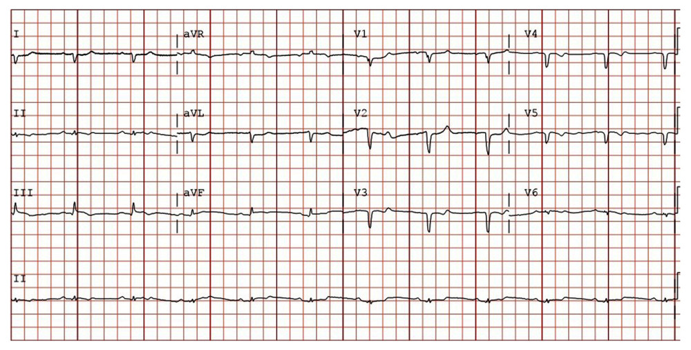 Electrocardiogram done after cardioversion, showing sinus rhythm.